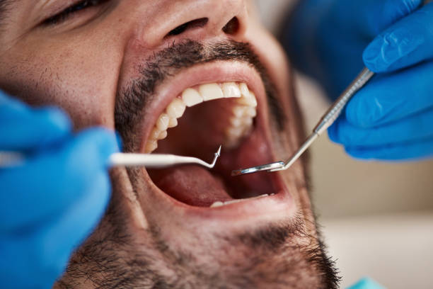 Best Chipped Tooth Repair Near Me  in Silsbee, TX